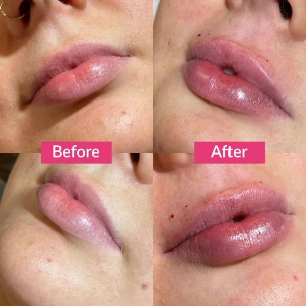 Lip filler before and after shots