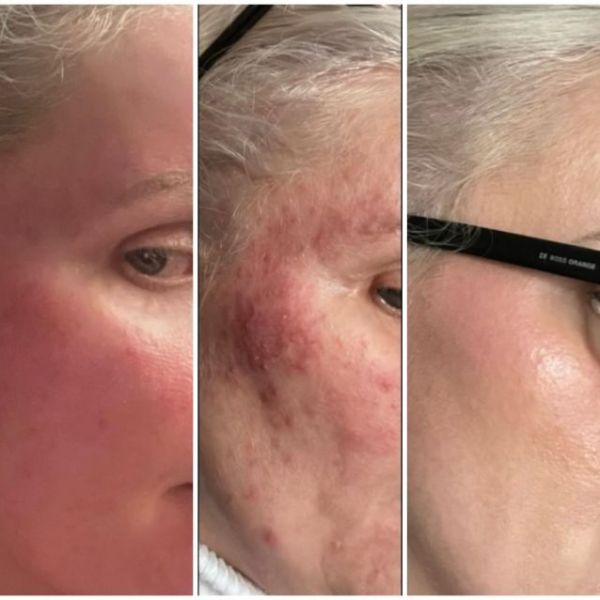 Side of face before and after.jpg